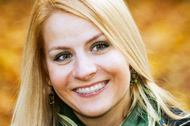 felnott fogszabalyozas 4