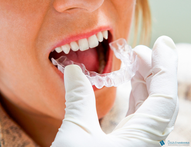 lathatatlan fogszabalyozas