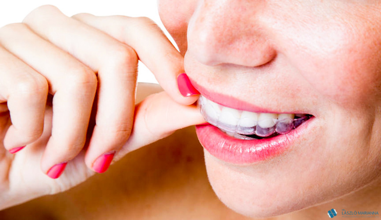 lathatatlan fogszabalyozas 2